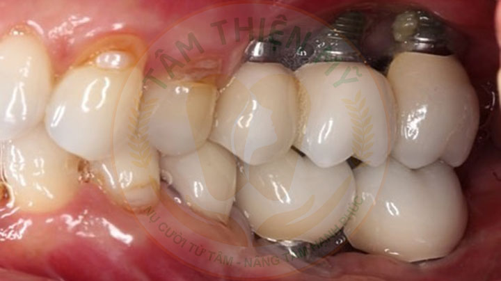 Trụ Implant bị đào thải có nguy hiểm không