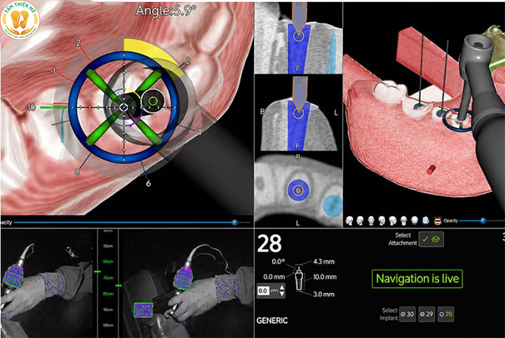 công nghệ cấy ghép implant định vị X-Guide