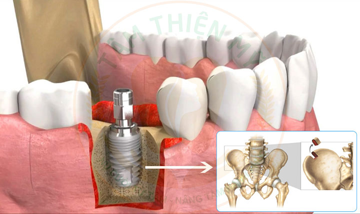ghép xương cấy implant