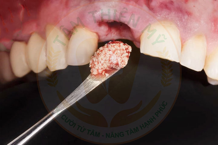 Giải mã kỹ thuật ghép xương răng Implant mới nhất 2026 6 ghép xương răng implant