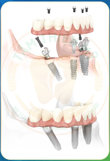 trồng răng implant ALL On 4