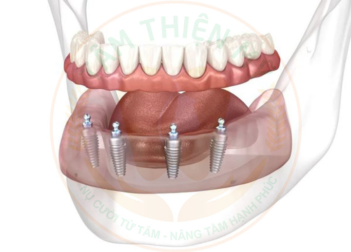 Hàm tháo lắp trên Implant là gì
