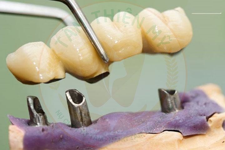 Trụ Implant bị đào thải