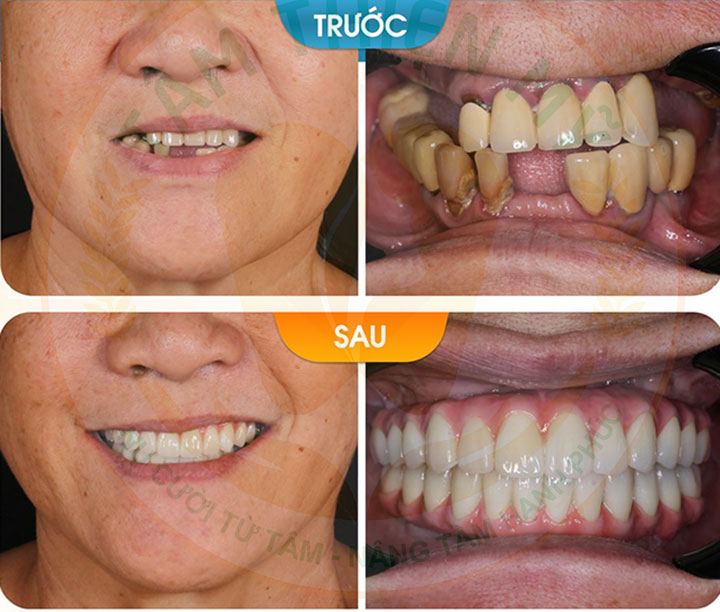 Quy trình làm hàm tháo lắp trên Implant tại Tâm Thiện Mỹ