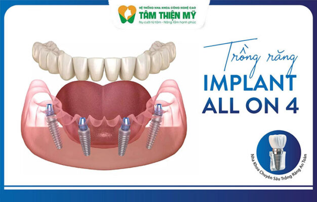 cấy ghép Implant All-on-4 tại Tâm Thiện Mỹ