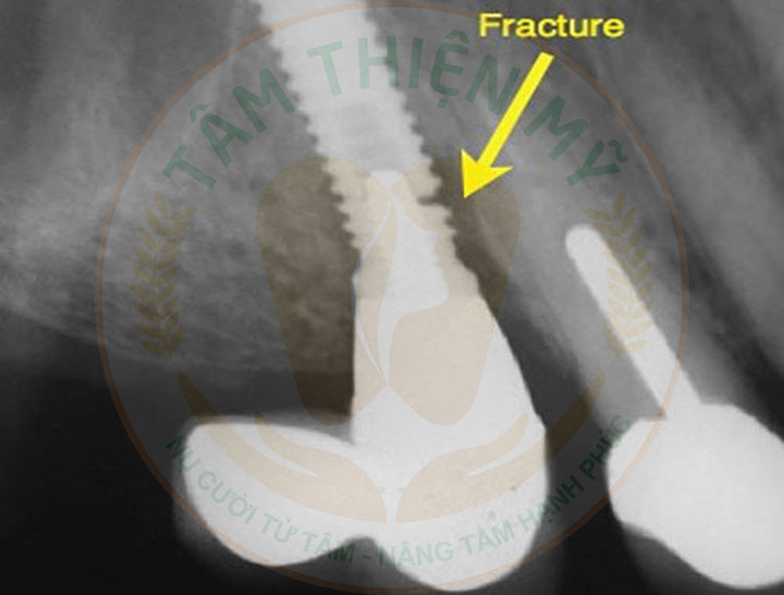 Răng implant lung lay - nguyên nhân - giải pháp khắc phục triệt 2 trụ implant bị gãy