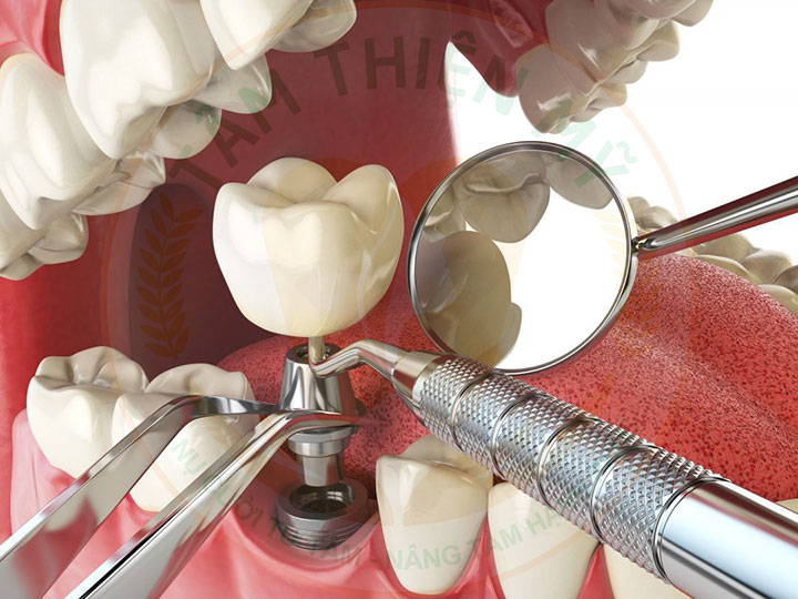 Răng implant lung lay - nguyên nhân - giải pháp khắc phục triệt 8 Phòng ngừa răng Implant bị lung lay