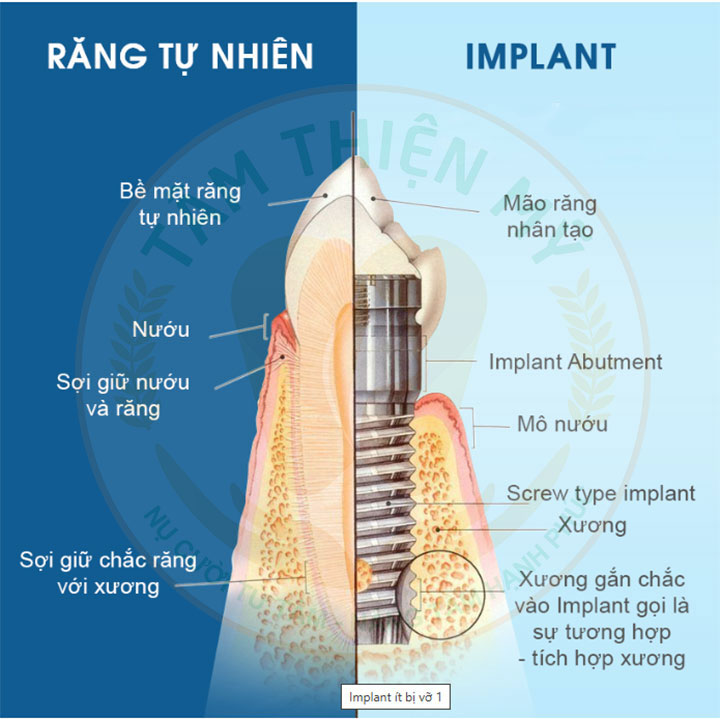 Trồng răng implant sử dụng được bao lâu? Bí kíp Implant trọn 3 tuổi thọ của răng Implant