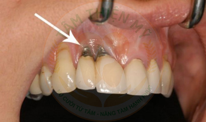 Răng implant lung lay - nguyên nhân - giải pháp khắc phục triệt 1 Răng Implant lung lay do trụ không tích hợp xương hàm