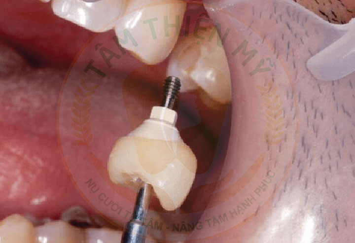 trụ Implant bị đào thải