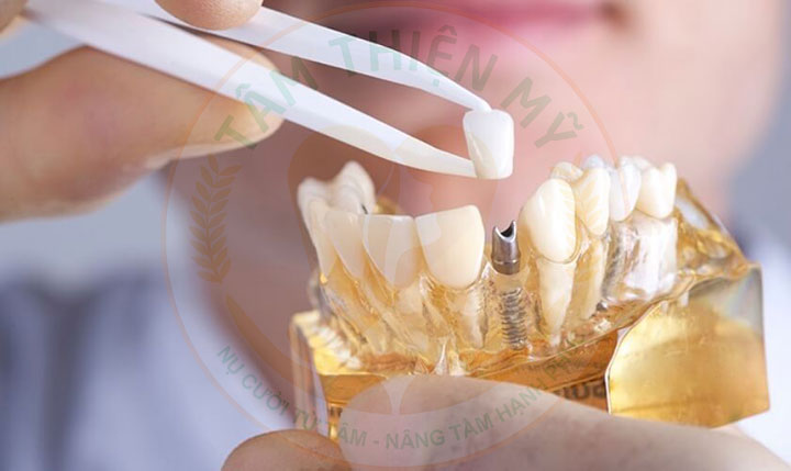 Răng implant lung lay - nguyên nhân - giải pháp khắc phục triệt 5 Làm gì khi trụ Implant lung lay