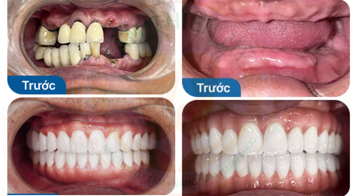 cấy implant toàn hàm