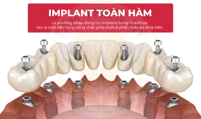 implant toàn hàm giá bao nhiêu