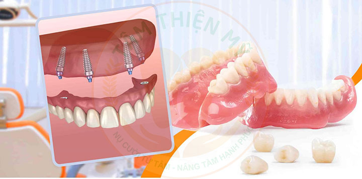 hàm giả tháo lắp