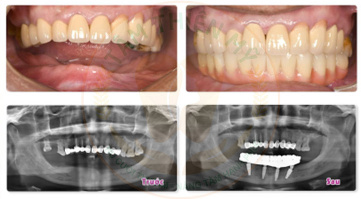 implant toàn hàm và hàm tháo lắp