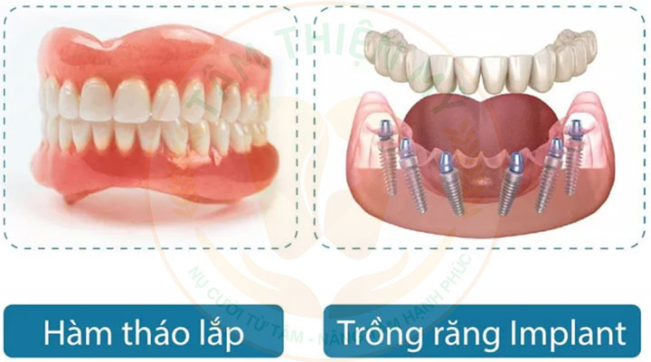 Nên trồng răng Implant toàn hàm hay dùng hàm tháo lắp