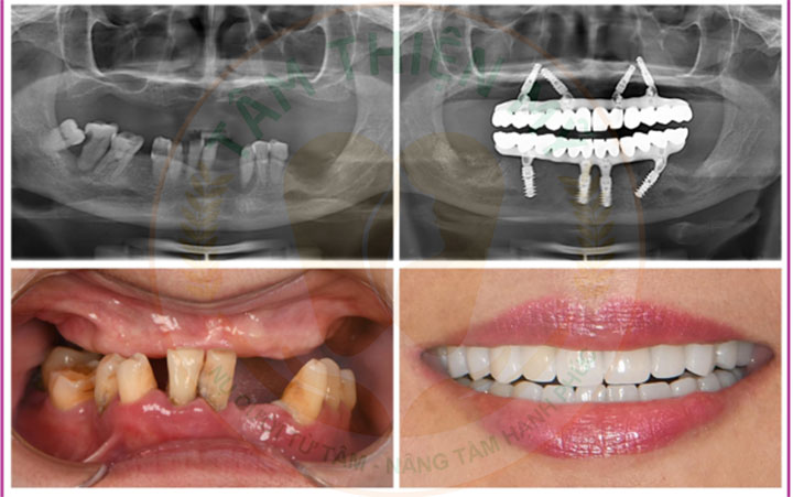 implant toàn hàm và hàm tháo lắp
