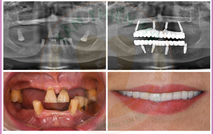 implant toàn hàm và hàm tháo lắp