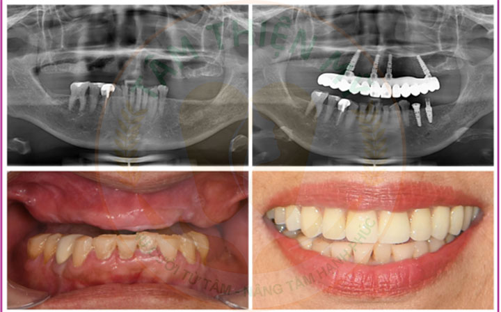 Cấy Implant toàn hàm và hàm tháo lắp phương án nào tối ưu? 8 implant toàn hàm và hàm tháo lắp