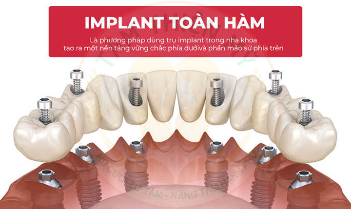 implant toàn hàm giá bao nhiêu