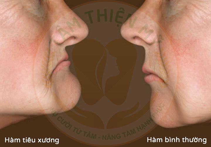 Người già rụng răng - nguyên nhân, cách khắc phục, biện pháp phòng ngừa 8 Người già rụng răng