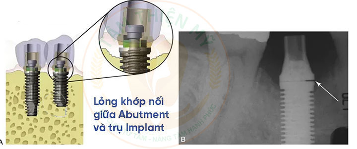 Răng implant lung lay - nguyên nhân - giải pháp khắc phục triệt 3 Răng Implant lung lay do lỏng khớp nối
