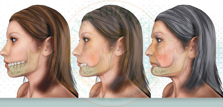 Người già rụng răng - nguyên nhân, cách khắc phục, biện pháp phòng ngừa 7 mất thẩm mỹ