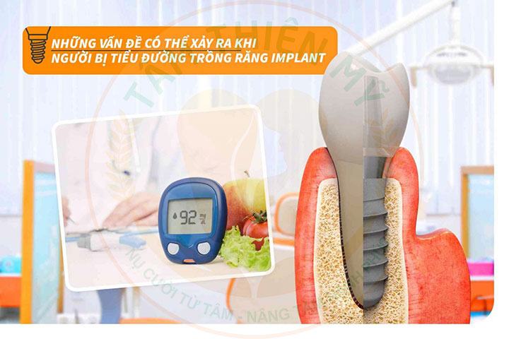 Nguyên nhân trụ Implant bị đào thải