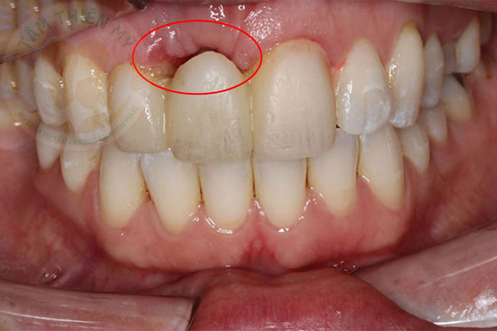 Bắc cầu răng sứ là gì? Phân loại - Ưu - nhược điểm của cầu răng sứ 9 nhược điểm cầu răng sứ