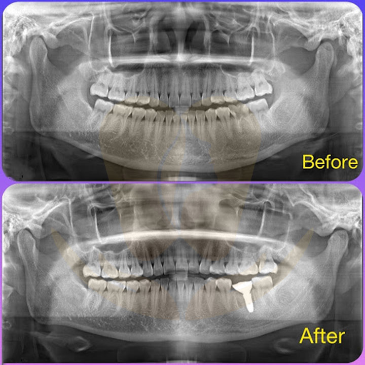 Cấy ghép implant công nghệ chịu lực tức thì