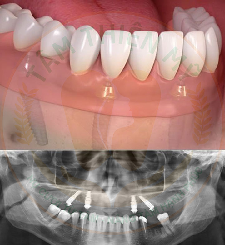 cấy ghép Implant All-on-4 tại Tâm Thiện Mỹ