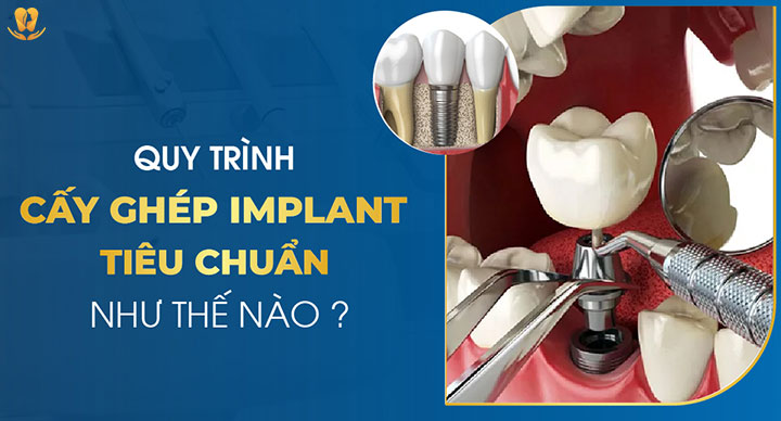 Quy trình trồng răng Implant chuẩn y khoa