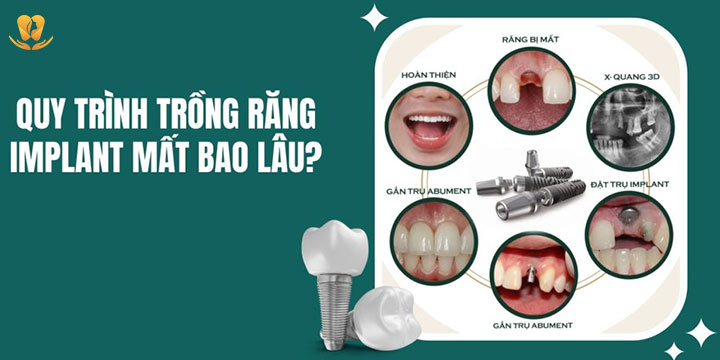 Hoàn tất quy trình trồng răng implant mất bao lâu