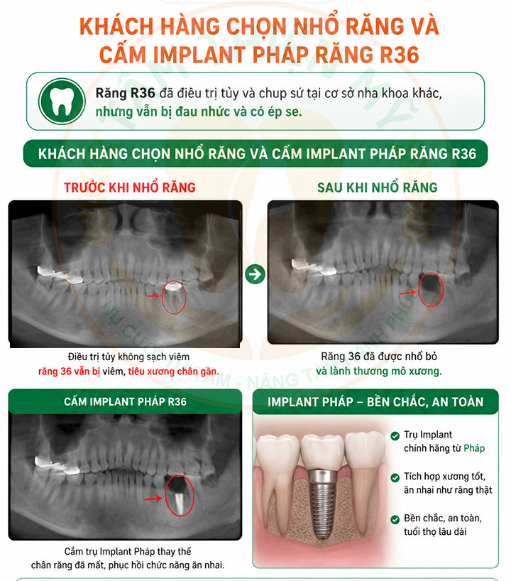implant tức thì