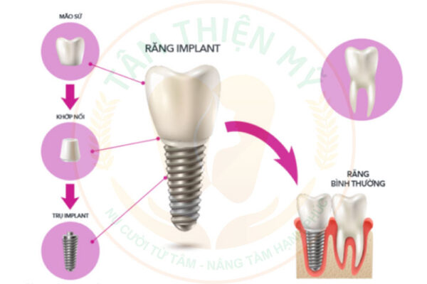 Mất răng nên làm cầu răng sứ hay trồng răng Implant