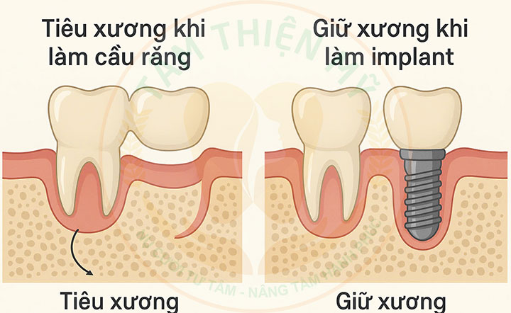 So sánh cầu răng và Implant nên chọn loại nào? 3 So sánh cầu răng và Implant