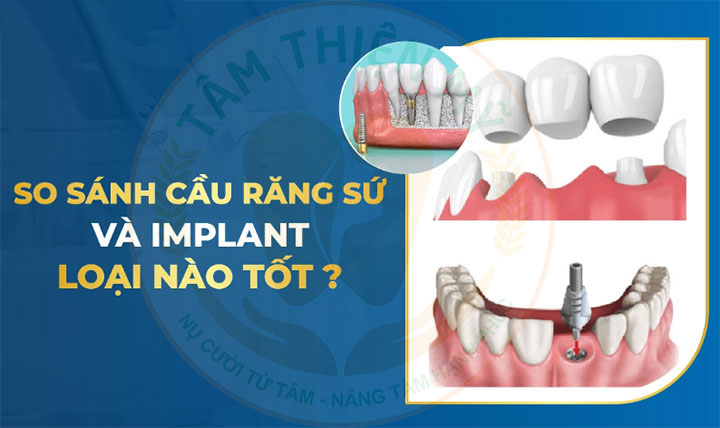 So sánh cầu răng và Implant