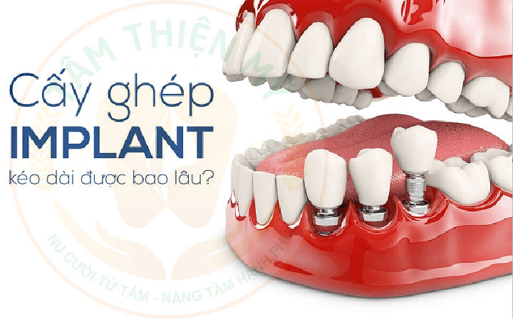 Trồng răng implant sử dụng được bao lâu? Bí kíp Implant trọn 2 Trồng răng Implant sử dụng được bao lâu