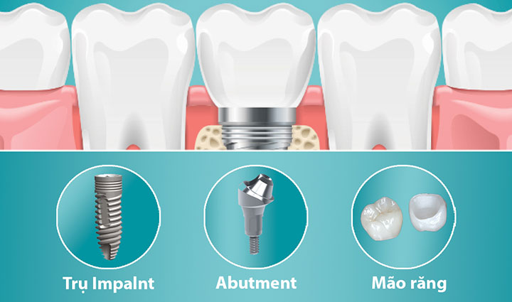 Trụ răng implant nào tốt nhất? Bảng giá các loại trụ Implant MỚI NHẤT 2026 8 tiêu chí chọn trụ implant