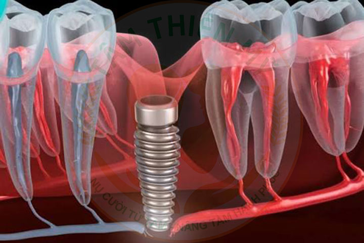 cấy răng implant giá rẻ