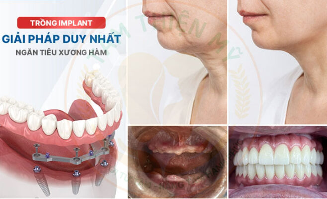 trồng implant dùng được bao lâu