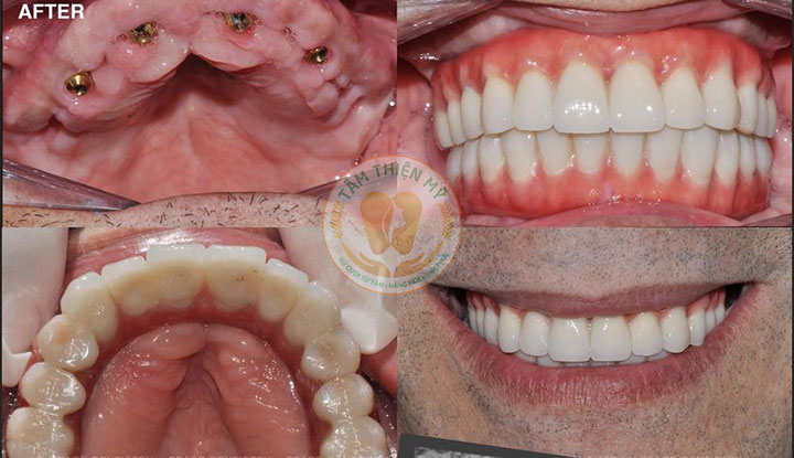 implant all in 4