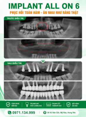 trồng răng implant all on 6