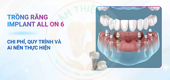 Trồng răng Implant All on 6