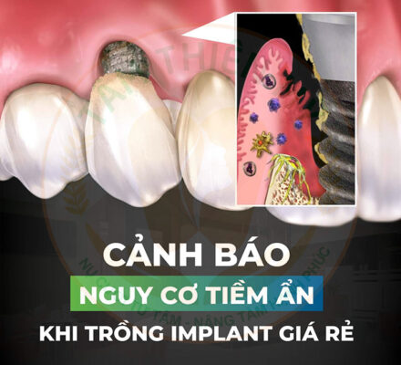 trong rang implant gia re 3 1