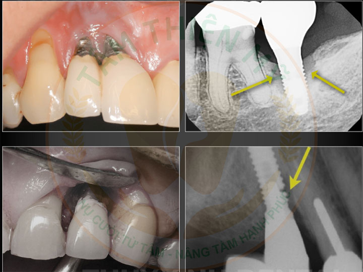 cấy implant giá rẻ