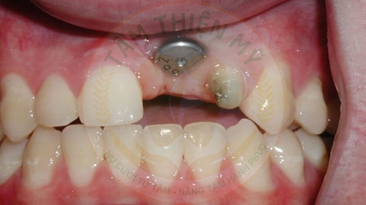 cáy implant giá rẻ