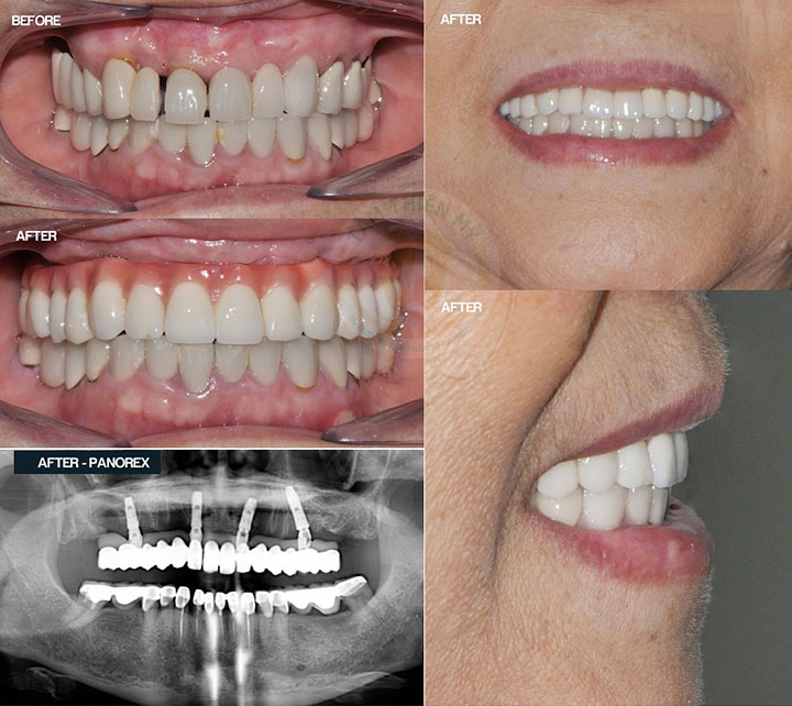 implant all in 4