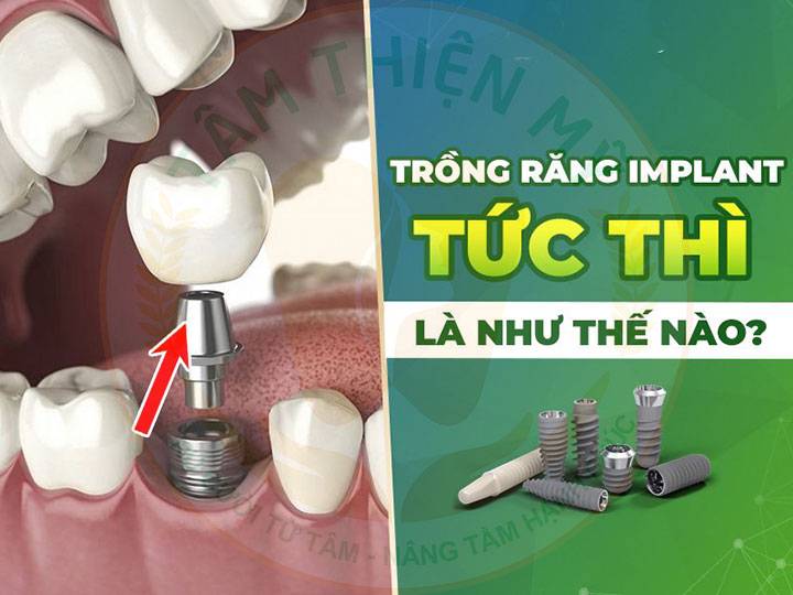 Cấy ghép implant công nghệ chịu lực tức thì là gì