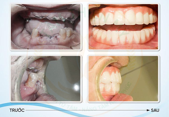 Kỹ thuật cấy ghép Implant công nghệ chịu lực tức thì